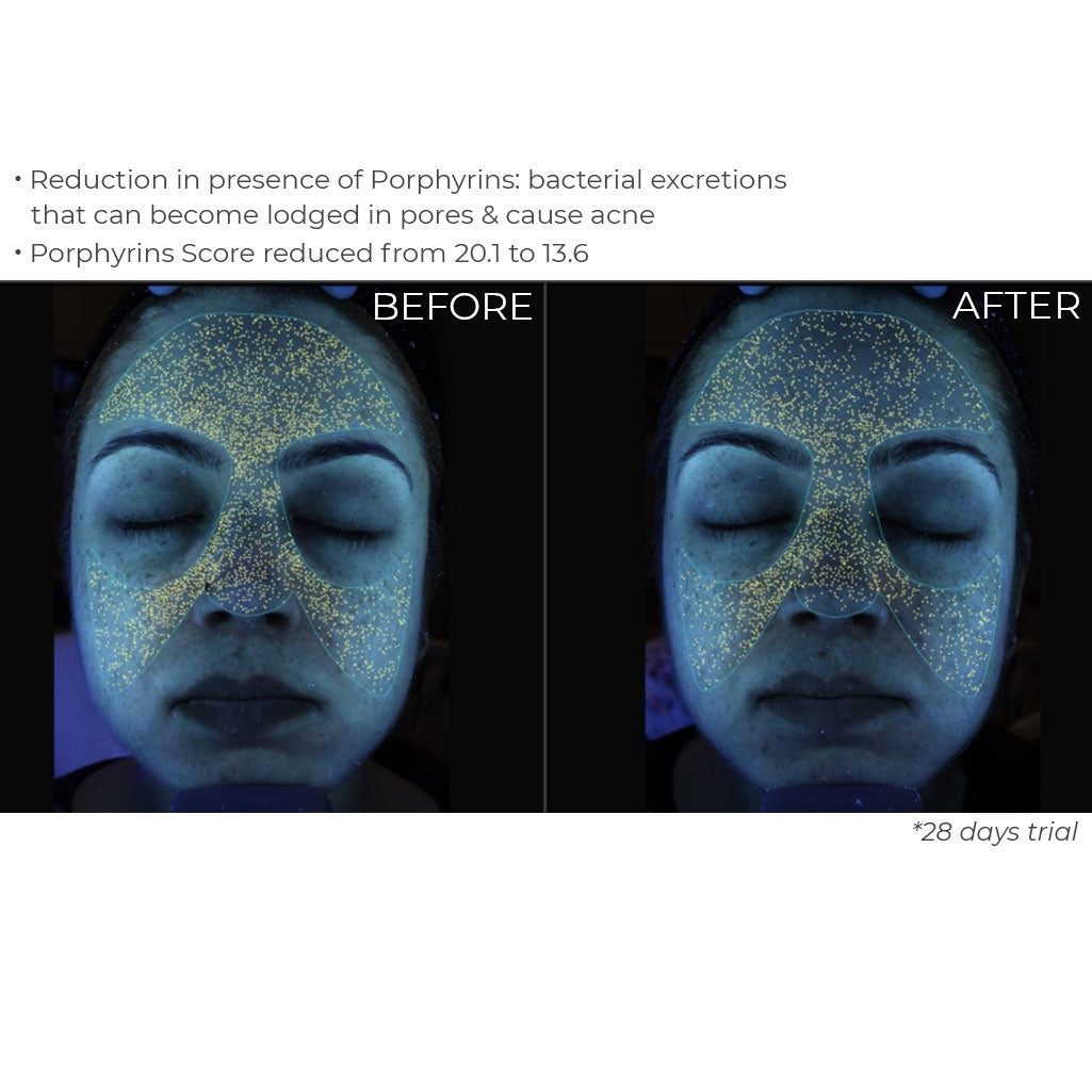 Nourish London Before After Radiance Firming Facial Oil Results Acne-Prone Skin