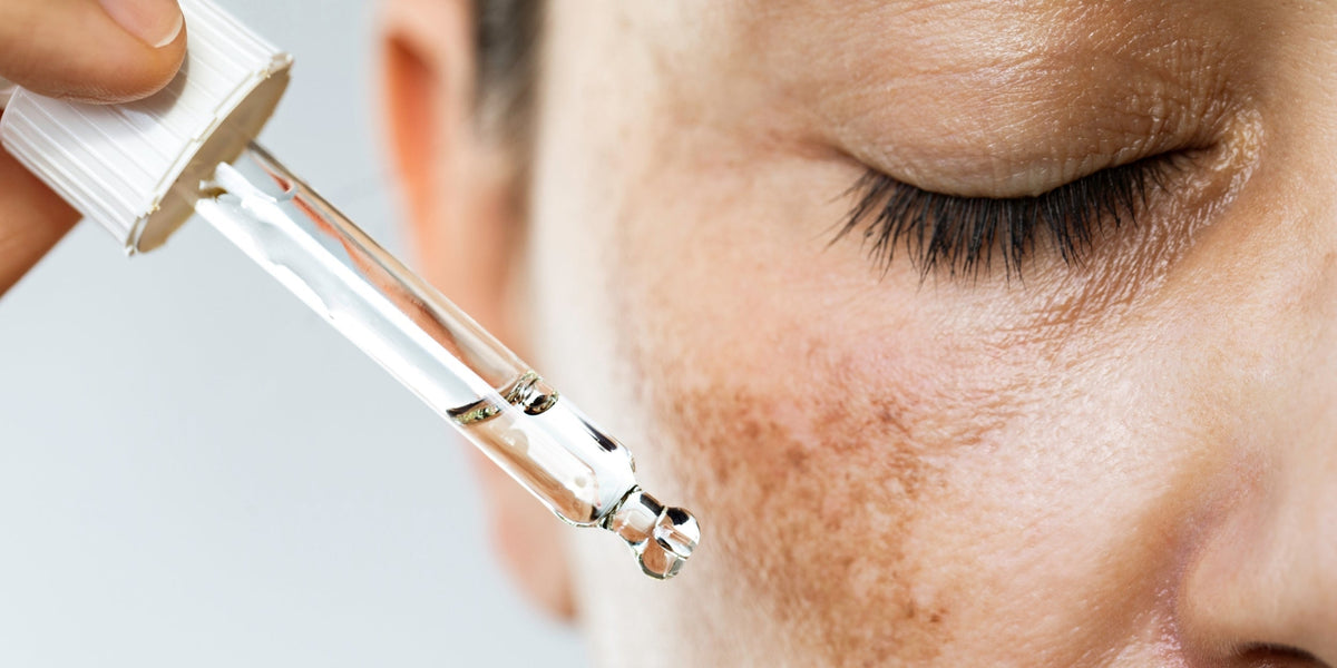 How to Treat Hyperpigmentation Without Harsh Chemicals